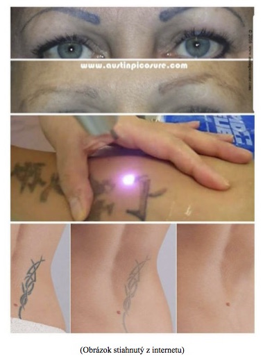 Odstranenie tetovania